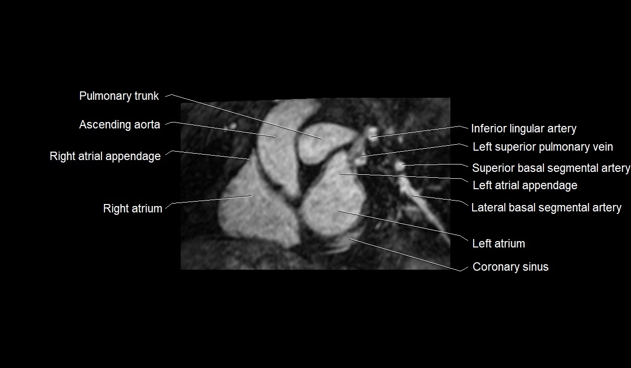 MRI heart and coronary arteries short axis anatomy image 13.webp